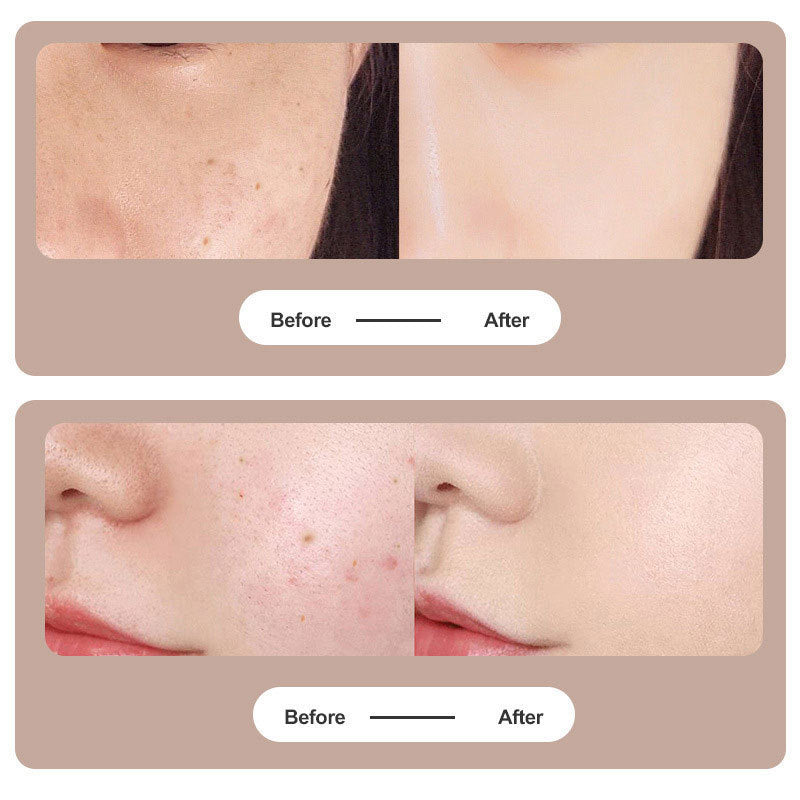 Plasma Pen - Tattoo Mole Removal & Dark Spot Remover Tool