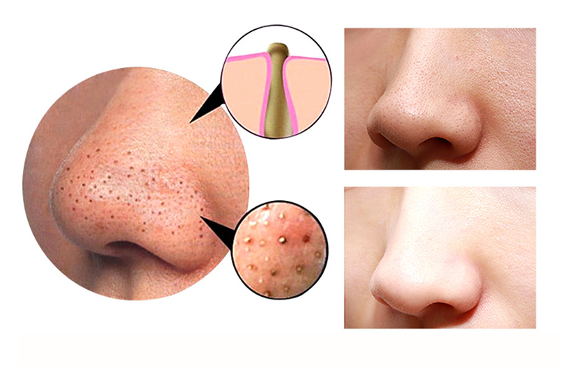4 in 1 Body Guasha Cupping Blackhead Remover