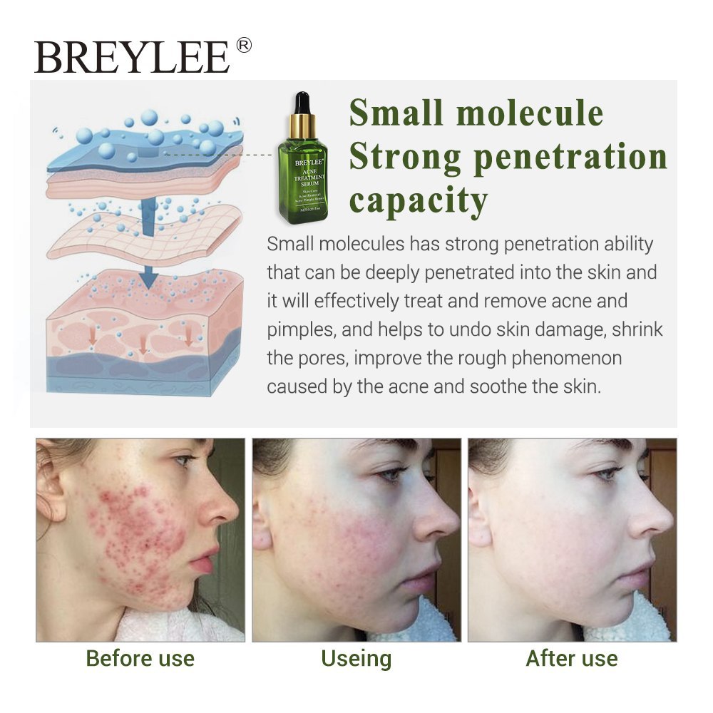 BREYLEE Acne Treatment Serum Ansiktsbehandling Anti Acne Ärrborttagning Kräm Hudvård Whitening Repair Finnsborttagningsmedel för akne