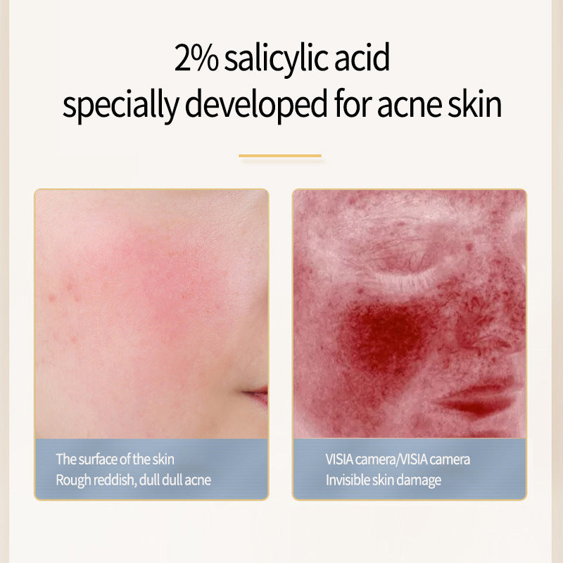 Acneborttagning av salicylatprodukter