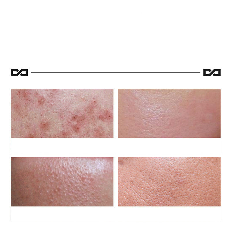 Herbal Lightening Acne Cream Hudvård