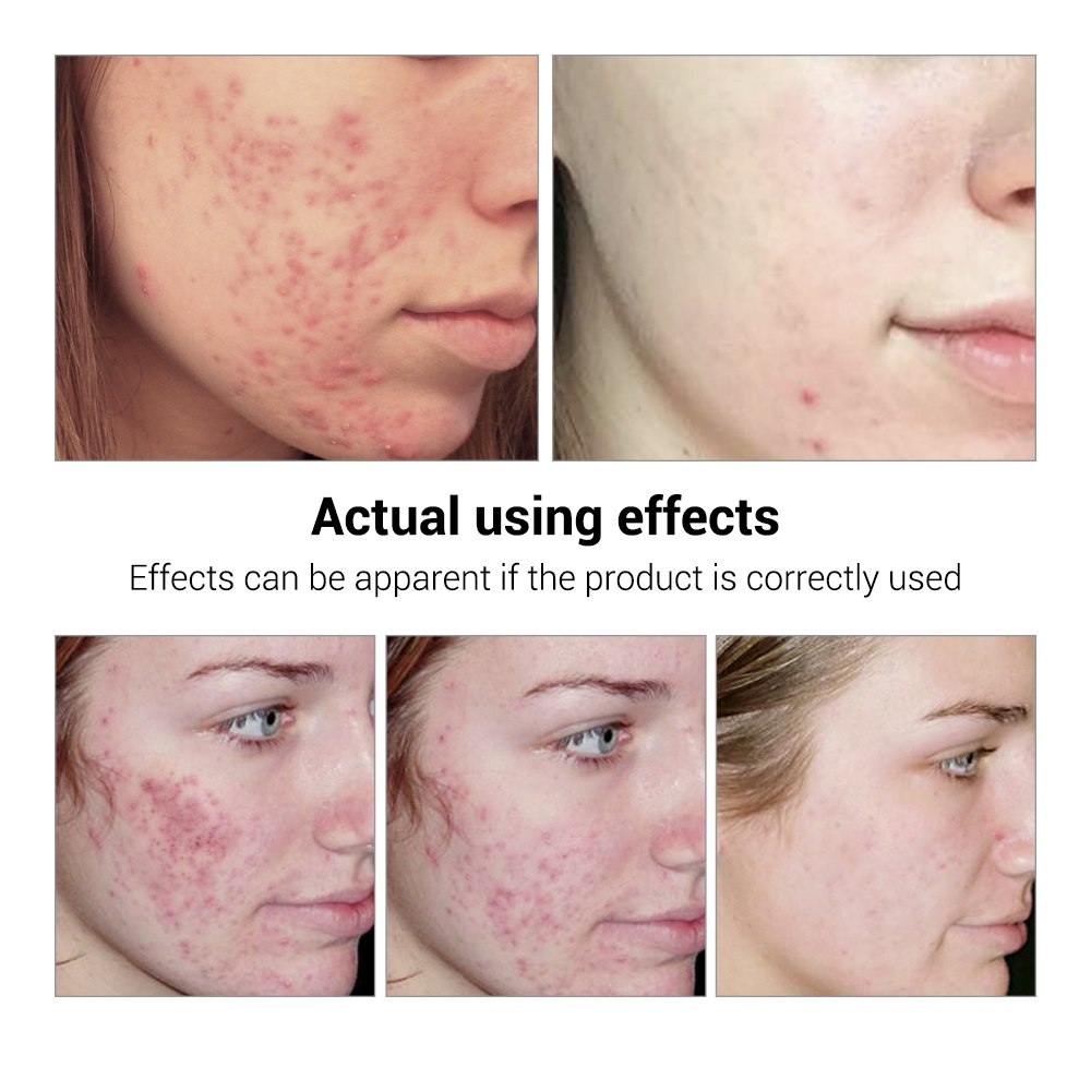 BREYLEE Acne Treatment Serum Ansiktsbehandling Anti Acne Ärrborttagning Kräm Hudvård Whitening Repair Finnsborttagningsmedel för akne