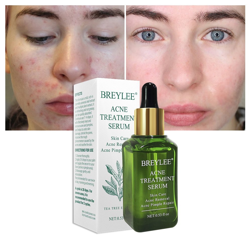 BREYLEE Acne Treatment Serum Ansiktsbehandling Anti Acne Ärrborttagning Kräm Hudvård Whitening Repair Finnsborttagningsmedel för akne