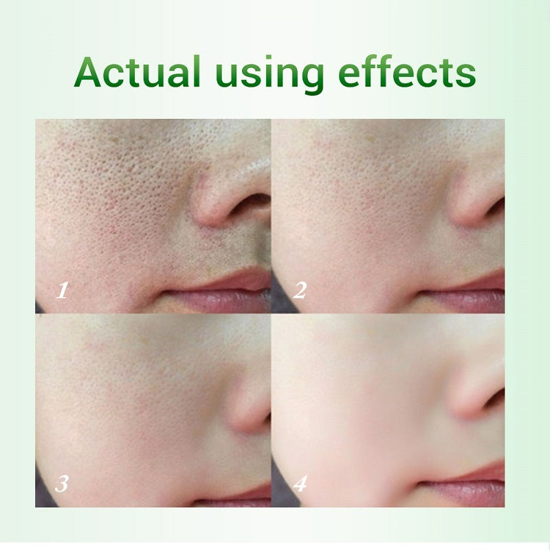 Salicylsyra Pore Refinement Cream Lotion Skin Rejuvenation Cream Hudvårdsprodukter