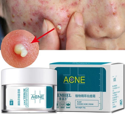 Acne kräm