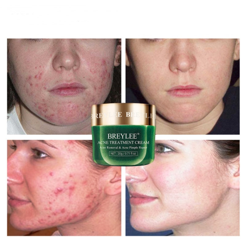 Tea tree acne cream moisturizing acne cream