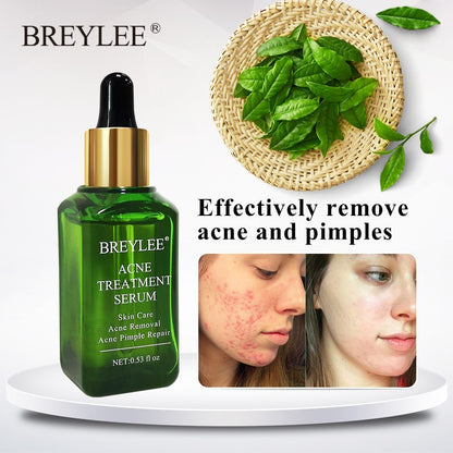 BREYLEE Acne Treatment Serum Ansiktsbehandling Anti Acne Ärrborttagning Kräm Hudvård Whitening Repair Finnsborttagningsmedel för akne 