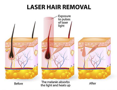 Hårborttagningsapparat med laser