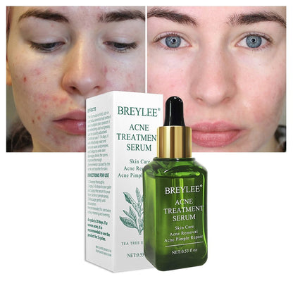 BREYLEE Acne Treatment Serum Ansiktsbehandling Anti Acne Ärrborttagning Kräm Hudvård Whitening Repair Finnsborttagningsmedel för akne 